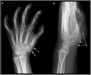 Radiografía convencional. Paciente de 13 años con una tumoración dolorosa en la eminencia tenar de la mano izquierda. Diagnóstico final de SS. Radiografía de la mano izquierda en proyección AP (A) y lateral (B), donde se observa una imagen redondeada con densidad de partes blandas en la región tenar izquierda (flecha) que asocia calcificaciones periféricas en su vertiente posterior (flechas discontinuas).