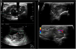 Ultrasonido. A) Adolescente de 16 años con un SS multiquístico en la región axilar izquierda. La imagen superior muestra una tumoración de comportamiento predominantemente quístico (asterisco) y morfología ovalada con bordes lobulados, diámetro longitudinal aproximado de 10cm, así como contenido ecogénico por presencia de sangrado y depósito de fibrina (punta de flecha). La imagen inferior en modo Doppler color enfoca un polo sólido (flecha discontinua) con vascularización presente en septos de la tumoración (flecha). B) Paciente de 13 años con un SS típicamente nodular en la eminencia tenar de la mano izquierda. La imagen superior muestra una tumoración sólida hipoecoica y heterogénea, de bordes lobulados y bien definidos, con un diámetro mayor aproximado de 3cm. En la imagen inferior con estudio Doppler color se evidencia vascularización intratumoral.