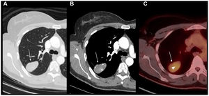 Paciente de 57 años con un SS típicamente nodular de localización pulmonar. TC en corte axial con ventana de pulmón (A) y ventana de partes blandas (B) tras la administración de contraste yodado. Se observa un tumor sólido y bien delimitado en el lóbulo superior derecho (flecha), hipodenso respecto al músculo (flecha discontinua), morfología ovoidea y que presenta áreas de realce heterogéneo tras la administración de contraste yodado (asterisco). PET-TAC 18F-FDG (C): Imagen fusionada en corte axial que muestra hipercaptación del radiotrazador en el tumor (punta de flecha); el rastreo de cuerpo completo excluyó enfermedad metastásica (no mostrado).