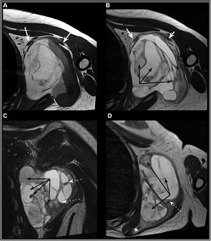 Adolescente de 16 años con un SS multiquístico en la región axilar izquierda. RM sin Gd, secuencias potenciadas en T1 (A: axial) y T2 (B: axial en tercio medio del tumor, C: coronal, D: axial en tercio inferior del tumor). Tumoración quística, tabicada, polilobulada y bien delimitada, que se extiende anteriormente desplazando los vasos axilares y ramos del plexo braquial (flechas), así como la musculatura pectoral y subescapular (A y B). Sobrepasa posteriormente el plano de la escápula y presenta una lobulación que se proyecta sobre el músculo redondo menor (asterisco). En las imágenes se aprecia densidad variable por contenido seroso, hemático y fibroepitelial («signo triple» - flechas negras) y niveles «líquido-líquido» (flechas discontinuas) que le confiere el aspecto típico en «tazón de uvas».