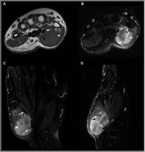 Paciente de 13 años con un SS típicamente nodular en la eminencia tenar de la mano izquierda. RM sin Gd, secuencias potenciadas en T1 (A: axial) y T2-FatSat (B: axial, coronal, D: sagital). Tumoración sólida de morfología nodular y márgenes lobulados localizada en la eminencia tenar, isointensa respecto al músculo en T1 e hiperintensa en las secuencias T2-FatSat con un aspecto heterogéneo en estas últimas. Presenta una estrecha relación con el primer metacarpiano y los tendones de la musculatura flexora, englobando al tendón del flexor largo del pulgar (flecha blanca) y desplazando al músculo abductor corto del pulgar (punta de flecha). Se observan calcificaciones distróficas en su interior (flechas discontinuas) y algún foco de microhemorragia intratumoral (flecha negra en A). La variabilidad en la intensidad de señal por los diferentes componentes intratumorales (aunque predominantemente celular), corresponde al «signo triple».