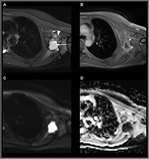 Adolescente de 16 años con un SS multiquístico en la región axilar izquierda. Control postquirúrgico donde se demuestra enfermedad residual. Inicialmente se consideró como un proceso benigno (linfangioma quístico gigante complicado con hemorragia intraquística), por lo que el abordaje resultó subóptimo al no incluir terapia neoadyuvante. La paciente no presentaba clínica ni parámetros analíticos compatibles con infección. RM en corte axial con secuencias T2-FatSAt (A), T1 + Gd (B) y estudio de difusión con mapa ADC (C y D). Se observa una tumoración de comportamiento quístico (hiperintensidad en T2) en la región axilar (flecha) con cambios postquirúrgicos en el tejido blando adyacente (punta de flecha). Tras la administración de Gd se aprecia un realce predominantemente periférico de la lesión (flechas discontinuas), así como restricción en difusión.
