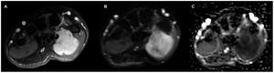 Paciente de 13 años con un SS típicamente nodular en la eminencia tenar de la mano izquierda. RM en corte axial con secuencias T1-FatSat + Gd (A) y estudio de difusión con mapa ADC (B y C). Tumoración sólida con realce prominente y difuso tras la administración de Gd que muestra restricción en el estudio de difusión.