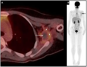 Adolescente de 16 años con SS multiquístico en la región axilar izquierda. Control postquirúrgico que demuestra enfermedad residual (flecha). Tomografía por emisión de positrones con [18F]Fluorodesoxiglucosa fusionada con TC (PET-TC 18F-FDG). Imagen fusionada en corte axial enfocado al tumor axilar (A) y rastreo de cuerpo completo (B). Se observa captación del radiotrazador en la periferia de la lesión (flechas discontinuas), sin evidenciar hipercaptación sospechosa a nivel ganglionar ni en otros tejidos distantes, lo que descarta afectación metastásica.