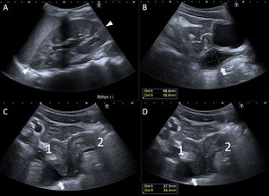 Ecografías abdominopélvicas. A) Riñón izquierdo único, compensador (cabezas de flecha, delimitando sus bordes). B) Colección líquida paravesical de 48 x 18mm con ecos finos internos (flecha). C y D) Malformación uterina con aparente útero bicorne bicollis con ambos cuerpos uterinos en anteflexión (1. derecho: 27mm / 2. izquierdo: 24mm), cada uno lateralizado hacia un lado, con colección adyacente a útero derecho (flecha). Ambos endometrios centrados.