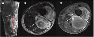 Determinación de las características morfológicas de los TPB en un sarcoma pleomórfico indiferenciado en una mujer de 56años. A)Medición del eje largo (línea roja) y determinación del edema perilesional (flechas blancas) en una T2 FS coronal. B)Tumor profundo (flecha blanca) según la relación con la fascia superficial (puntos naranjas), y lesión heterogénea con al menos un tercio del área con cambios en la intensidad de la señal. C)Realce de focos nodulares periféricos (flechas blancas) en T1 FS posgadolinio, y zonas de necrosis quística: focos hipointensos de al menos 2mm, sin realce en T1 FS posgadolinio (flechas negras).