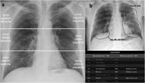 a) Radiografía posteroanterior de tórax con hallazgos normales. División de la radiografía en 6 campos pulmonares. Para ello se trazó una línea horizontal superior (borde inferior del arco aórtico) y una línea horizontal inferior (borde inferior de la vena pulmonar inferior derecha).