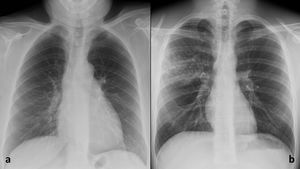 a) Radiografía posteroanterior de tórax con hallazgos compatibles con neumonía COVID-19 indeterminada. b)Radiografía posteroanterior de tórax con hallazgos compatibles con enfermedad no COVID-19 (neumonía bacteriana).