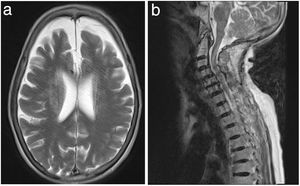 A) T2 axial del cerebro que muestra la presencia de artefactos de movimiento en una paciente de 53 años derivada por dolor de cabeza y debilidad generalizada del cuerpo. La paciente estaba en el grupo de control, su puntuación STAI era de 11, la frecuencia cardiaca basal era de 69 y la frecuencia cardiaca máxima durante la RM fue de 110. B) RM T2 sagital de la columna cervical en una mujer de 58 años derivada por lumbalgia irradiada a la extremidad inferior derecha clasificada en el grupo de asesoramiento con un consultor, que muestra la presencia de artefactos de movimiento que degradan significativamente la calidad de la imagen. Sus puntuaciones STAI antes y después del asesoramiento fueron de 12 y 14, respectivamente, su frecuencia cardiaca basal fue de 85 y la máxima de 112. RM: resonancia magnética; STAI: State-Trait Anxiety Inventory.