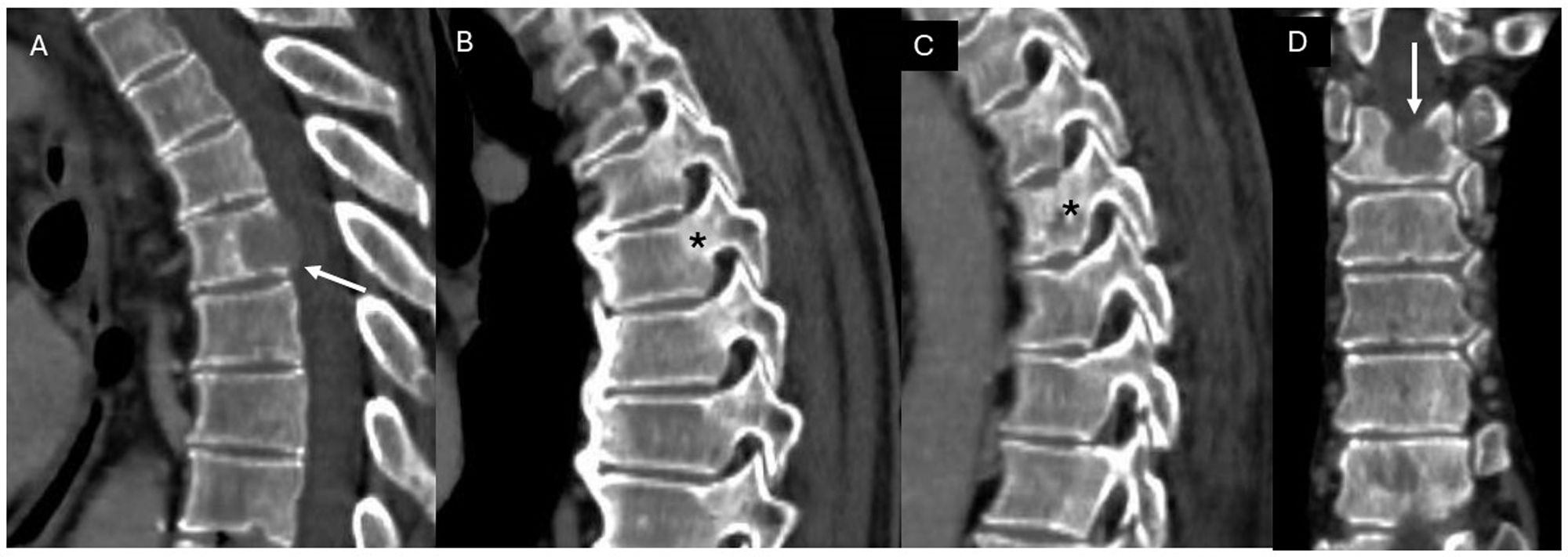 Columna Inestable Diagnóstico radiológico del síndrome de compresión medular oncológico ...