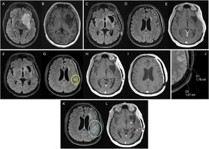 Hombre de 32 años con diagnóstico de astrocitoma grado 4 IDH-mutado a nivel frontoinsular izquierdo. RM diagnóstica con secuencias FLAIR (A) y T1 poscontraste (B). RM basal correspondiente a RM posradioterapia, con alteración de señal pericavidad en FLAIR (C), sin afectación parietal (D), ni captación de contraste (E). Tras 20 meses de seguimiento, en una nueva RM de control (F-J), se observa una nueva lesión no captante medible (círculo amarillo) a nivel parietal, correspondiente a progresión de la enfermedad. Se decide realizar una nueva RM de control (K,L), reafirmando la progresión de la enfermedad tras el aumento de la lesión no captante (círculo azul) y aparición de diseminación leptomeníngea (flecha). Existe también un componente captante pericavidad (asterisco), pero no es medible. IDH: gen isocitrato deshidrogenasa; RM: resonancia magnética.