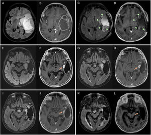 Glioblastoma en una mujer de 67 años a nivel temporoinsular izquierdo. Control radiológico evolutivo valorado en secuencias FLAIR y T1 poscontraste, desde la RM diagnóstica (A, B), RM posquirúrgica 48 horas (C,D), RM posradioterapia correspondiente a la RM basal (E,F) a RM de 1.° (G,H), 2.° (I,J) y 3.° (K,L) control. La RM posquirúrgica 48 horas muestra resección completa del componente captante tumoral (cabezas de flecha). Existe en la RM basal una lesión medible captante de contraste (flecha), que en el 1° control no muestra cambios (enfermedad estable), en el 2° control muestra reducción de tamaño (respuesta parcial) y en el 3° control desaparece (respuesta completa). En los siguientes controles esta última RM será la RM de comparación al ser la RM con mejor respuesta. RM: resonancia magnética.