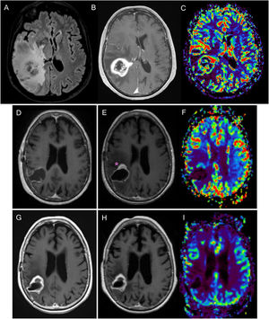 Mujer de 76 años con diagnóstico de glioblastoma parietal derecho demostrado en RM con secuencias FLAIR, T1 poscontraste y mapa de CBV en perfusión DSC (A,B,C). Resección completa del componente captante en la RM posquirúrgica 24 horas (D). En la RM posradioterpaia (E,F), correspondiente a la RM basal, existe un área nodular parietal de captación contraste (asterisco) sin aumento significativo de volumen en el mapa de CBV del estudio de perfusión DSC (F). En los siguientes controles, seis semanas (G) y 12 semanas posconcomitancia (H, I) se observa una reducción de tamaño del área captante, sin aumento del volumen (I), hallazgos en relación con pseudoprogresión. CBV: volumen sanguíneo cerebral; DSC: perfusión mediante susceptibilidad magnética dinámica; RM: resonancia magnética.