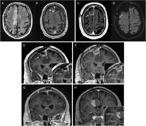 Hombre de 82 años con diagnóstico de glioblastoma en el giro frontal superior derecho. RM de diagnóstico con secuencias FLAIR (A) y T1 poscontraste (B), observando una pequeña captación focal frontal paramedial anterior (cabeza de flecha). En la RM posquirúrgica (C,D,E) se observa la captación pericavidad sin alteración en la difusión (D) correspondiente a resto tumoral (flechas). Se realiza una RM prerradioterapia observando un aumento de tamaño del componente captante, ahora medible (F). En la RM posradioterapia correspondiente a la RM basal, se identifica la desaparición del componente captante (G). En la 1.° RM control tres meses posconcomitancia (H), se evidencia una nueva lesión medible concluyente de progresión de la enfermedad. RM: resonancia magnética.