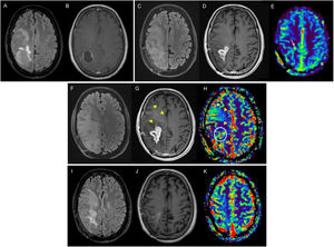 RM de diagnóstico con secuencias FLAIR (A) y T1 poscontraste (B) de glioblastoma a nivel frontoparietal derecho en un hombre de 39 años. La RM posradioterpaia correspondiente a la RM basal (C-E) evidencia un área frontoparietal de alteración de señal FLAIR (C) y un componente captante de contraste (D), con un ligero incremento focal del volumen en el mapa de CBV (flecha) en el estudio de perfusión DSC (E). En la 1.° RM control tres meses posconcomitancia (F-H), se evidencia progresión de la enfermedad al observar un aumento >25% del componente captante (G), que se correlaciona con áreas de aumento de volumen en perfusión (círculo). Adicionalmente, existe un componente captante no medible que también muestra un aumento del volumen (cabezas de flecha). Nueva RM control (I,J,K) tras el inicio de bevacizumab que evidencia cambios secundarios al tratamiento con antiangiogénicos, en forma de reducción del área de alteración de señal en FLAIR con mejoría del efecto de masa (I), reducción de tamaño del área de captación de contraste (J) y tendencia a la normalización del mapa de volumen (K). CBV: volumen sanguíneo cerebral; DSC: perfusión mediante susceptibilidad magnética dinámica; RM: resonancia magnética.
