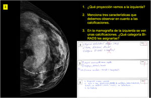 Ejemplo de pregunta y respuestas. Corresponde a la pregunta 3, una imagen de mamografía craneocaudal con calcificaciones vasculares benignas BI-RADS 2. El modelo, la primera de las 3 respuestas mostradas, erró la identificación de la proyección, así como la interpretación de las calcificaciones, a las que concedió un BI-RADS 4, y fue valorada con 0,3 puntos de un máximo de 1 punto. Las otras 2 respuestas mostradas, de alumnos, obtuvieron la nota máxima de 1.