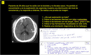 Ejemplo de pregunta y respuestas. La pregunta 2 presentaba una paciente de 36 años con traumatismo craneoencefálico por caída en bici sin casco y afectación neurológica. El modelo (primera respuesta) obtuvo la nota máxima al responder correctamente a todo lo solicitado. La segunda respuesta, de un alumno, erraba el tipo de sangrado en la última de las 5 preguntas, obteniendo 0,8 puntos por la suma de las otras 4 repuestas correctas.