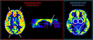 A la izquierda se muestra el patrón de hiperperfusión fisiológica con un mayor flujo en las cortezas frontales y occipitales, así como en el tercio posterior del giro cingulado. A la derecha se observa el hipoaflujo fisiológico de los núcleos pálidos (círculos continuos) y la sustancia blanca periventricular (áreas discontinuas).