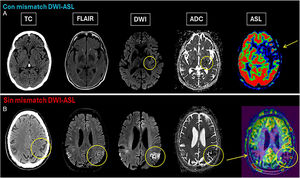 A)Varón de 80años con clínica de hemiparesia derecha y afasia de dos horas de evolución. Se realiza TC y estudio RM. Únicamente se aprecia en la difusión un foco de restricción en la porción posterior del núcleo lenticular (círculo) correspondiente con infarto agudo. El mapa de ASL muestra una caída del flujo en todo el territorio silviano (flecha). En este caso existe un área de penumbra isquémica extensa, con discrepancia (mismatch) entre la difusión y el ASL. B)Varón de 74años en el que se activa código ictus por clínica deficitaria hemisférica izquierda. En la TC basal se observa una pérdida de la diferenciación entre corteza y sustancia blanca en la convexidad parietal izquierda en relación con infarto isquémico agudo (círculo). En este caso no hay discrepancia entre el área de infarto agudo en difusión y el área de hipoaflujo en ASL (círculos). No se logró identificar defectos de repleción en la secuencia TOF. Además, este paciente presentaba una lesión temporoparietal derecha (parcialmente incluida en estas imágenes y señalada con flecha). Esta se muestra en la TC como una hipodensidad subcortical con ribete cortical. En la RM aparece como hiperintensidad cortical en FLAIR, sin restricción a la difusión, con ADC normal y bajo CBF (flecha). Imagen compatible con un infarto isquémico subagudo.