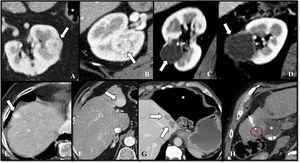 Localizaciones de alto riesgo (flechas) para termoablación percutánea. En el riñón (A-D): A) valva anterior cerca del colon (*), B) cerca del hilio o C-D) cerca del tracto urinario (*). En el hígado (E-H): E) tumores subfrénicos, F) subcapsulares, G) cercanos al colon (*) o H) cercanos a la vesícula biliar (*). El círculo discontinuo en la imagen H muestra un tumor cerca de la vesícula biliar (se observa la aguja de ablación térmica en el interior de la lesión).