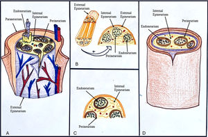 Cambios en las capas nerviosas debido a la lipomatosis, enfatizando el crecimiento excesivo y la infiltración grasa característica de la afección. A y B) Nervio normal. C y D) Lipomatosis del nervio. Endoneuro: muestra depósitos grasos dispersos, provocando un aspecto desorganizado de las fibras nerviosas. Perineuro: aparece engrosado y expandido debido a la infiltración adiposa. Epineuro: fuertemente infiltrado con grasa, lo que lleva a un ensanchamiento notable de los nervios y a una forma irregular.