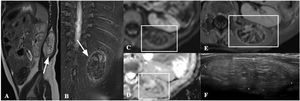 Lipoblastoma lumbar izquierdo en un lactante de 15 meses. A-E) RM abdominal. A) Sagital T1. B) Coronal T2 con supresión grasa. C y D) Estudio de difusión y mapa ADC. E) Axial T1 después de la administración de gadolinio. F) Ecografía lumbar. Lesión intramuscular de naturaleza sólida con bordes parcialmente definidos que se extiende desde el nivel L1 hasta el nivel L3, ocupando los músculos dorsal ancho izquierdo e iliocostolumbar, contactando con la apófisis transversa derecha de L1 (flechas). La lesión presenta supresión de señal en secuencias de saturación grasa, sugiriendo un tumor de origen adipocítico con restricción de difusión y realce de los tabiques internos (cuadrados). En la ecografía la lesión se presenta como una masa de bordes circunscritos con una ecoestructura homogénea ligeramente hiperecogénica.