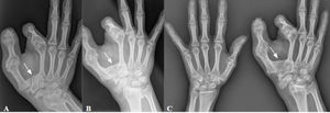 Seguimiento de LN en mujer diagnosticada de lipomatosis nerviosa y macrodactilia en la infancia (diagnosticada en otro hospital, no se dispone de imágenes previas). A) Radiografía de la mano derecha en 2016 (27 años). B) Radiografía de la mano derecha en 2019 (30 años). C) Radiografía de ambas manos en 2023 (34 años). Sobrecrecimiento óseo con deformidad del primer y segundo dedo, que conduce a la artrosis y anquilosis de las articulaciones trapeciometacarpianas con el paso de los años (flechas).