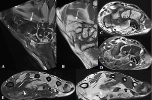 Mismo paciente que el de la figura 12. RM de muñeca derecha en 2024 para valoración de posible tratamiento. A) Coronal DP con supresión grasa. B) Coronal DP sin supresión grasa. C) Axial T1 del túnel carpiano. D) Axial DP con supresión grasa del túnel carpiano. E) Axial DP con supresión grasa distal al túnel carpiano. F) Axial T1 distal al túnel carpiano. Artrosis avanzada con anquilosis de las articulaciones trapeciometacarpianas (flechas), sobrecrecimiento e infiltración grasa del nervio mediano (asterisco), así como de la musculatura de la eminencia tenar (puntas de flecha). E: escafoides; G: ganchoso; Gr: grande; P: piramidal; S: semilunar.