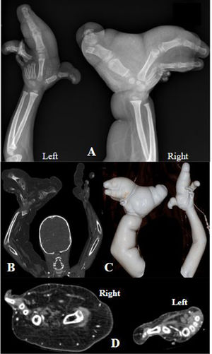 Lipomatosis del nervio con macrodactilia. Varón de 2 años con deformidad extrema de ambas manos y de toda la extremidad superior derecha, que afecta significativamente la movilidad del paciente. A) Radiografía de ambos antebrazos donde las partes blandas del antebrazo y brazo derecho son dos veces más grandes que el lado contralateral que es aparentemente normal. B-D) Angio-TC de miembros superiores con reconstrucción 3D. Aumento de volumen en ambas extremidades superiores debido a la severa proliferación de tejido fibroadiposo en el tejido subcutáneo y en algunos grupos musculares inervados por el nervio mediano.