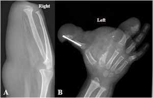 Radiografías posquirúrgicas del paciente de la figura 3. A) Radiografía lateral del antebrazo derecho. B) Radiografía PA de la mano izquierda. Amputación de mano derecha, preservando radio y cúbito, y estabilización del primer dedo de la mano izquierda mediante tornillo de osteosíntesis. Persiste macrodistrofia en antebrazo derecho y en mano izquierda.