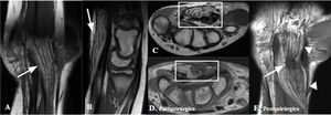 LN del nervio mediano en paciente de 12 años con síndrome del túnel carpiano y tratamiento con retinaculotomía. RM prequirúrgica de la mano derecha prequirúrgica. A) Coronal T1. B) Sagital T1. C) Axial T1. Engrosamiento fusiforme del nervio mediano, con fascículos engrosados separados por material graso (flecha). La infiltración del nervio mediano condiciona compromiso de espacio en el túnel carpiano, provocando el aplanamiento de los tendones flexores más cercanos a la lesión y la protrusión ventral del retináculo flexor (cuadrado). D) RM posquirúrgica de la mano derecha axial T1. E) RM posquirúrgica de la mano derecha coronal T1 sin contraste. Persiste engrosamiento del nervio mediano a lo largo de su recorrido visible con morfología bilobulada (puntas de flechas) con estrechamiento circular (1,5cm) en el retináculo flexor secundario a fibrosis posquirúrgica (flecha y cuadrados).