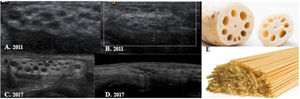 Hallazgos ecográficos de LN. Varón de 9 años con hamartoma fibrolipomatoso en el nervio mediano que presentaba parestesias y pérdida de la sensibilidad en la zona. A y B) Ecografía de muñeca en 2011, y C y D) en 2017. E) Raíz de loto y espagueti. Imagen fusiforme, mal definida, hiperecogénica con múltiples imágenes hipoecogénicas (signo «de raíz de loto») y aspecto en «espagueti» en la ecografía longitudinal (imagen D).