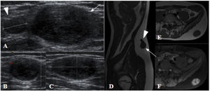 Schwannoma en un niño de 10 años que presenta un bulto en la región lumbar izquierda. A-C) Ecografía de tejidos blandos. Masa sólida, hipoecoica, bien definida y con refuerzo acústico posterior, de 29×15,5×15mm (flecha), localizada en tejido celular subcutáneo de la región lumbar izquierda, con presencia, aunque escasa, de flujo Doppler en su interior. Se observa otra lesión satélite adyacente a la descrita, de características similares (punta de flecha). D-F) RM del mismo paciente. D) Sagital T1. E) Axial T1. F). Axial T1 con contraste y supresión de grasa. Lesión focal bien definida dentro del espesor del tejido celular subcutáneo con morfología bilobulada (flecha, punta de flecha). Homogénea e isointensa al músculo en secuencias T1. Realce intenso después de la administración de contraste, excepto en la región central (signo de la diana).