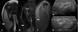 Lipoma intramuscular. Hallazgos en RM y ecografía en un niño de 9 años con una masa en el deltoides derecho. A-C) RM centrada en el húmero. A) Coronal T1. B) Coronal STIR. C) Sagital T1 con supresión grasa tras la administración de contraste intravenoso. Lesión intramuscular bien definida en el deltoides derecho, predominantemente hiperintensa en T1 y con caída de señal en secuencias con saturación de grasa (flechas), sin realce tras la administración de contraste. E y F) Ecografía del deltoides. Se identifica una lesión intramuscular bien definida hiperecogénica en ecografía sin el punteado hipoecogénico característico de la LN y sin flujo en el estudio Doppler.
