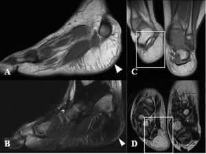 Lipomatosis difusa en el talón de un niño de 3 años con pie zambo. RM de los pies. A) Sagital T1 del pie derecho. B) Sagital T2 con supresión grasa del pie derecho. C) Coronal T1. D) Axial T2. Aumento del grosor del tejido adiposo por debajo del calcáneo derecho de 25mm en comparación con la medida de 16mm del área equivalente en el pie sano contralateral (cuadrados). No se observa cápsula ni signos de agresividad, todo ello compatible con crecimiento excesivo de tejido graso (puntas de flechas).