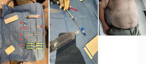 Preparación para infiltrar TB en pared abdominal. En A, material necesario para la infiltración de la pared abdominal: 1)jeringa de carga para diluir el fármaco en su interior, 2)llave de tres pasos, 3)funda de sonda ecográfica, 4)agujas de carga, 5)agujas espinales 22G para infiltración de musculatura, 6)jeringa de insulina (1ml) para coger el fármaco del vial, 7)jeringas para infiltrar. En B, paso de la toxina diluida en 1ml a una jeringa de mayor capacidad con llave de tres pasos. En C, paciente con marcaje del lado derecho y cambios posquirúrgicos en pared abdominal anterior que condicionaban una eventración con pérdida de dominio; posteriormente se le colocó en decúbito lateral para facilitar la punción.
