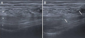 Infiltración de TB en pared abdominal. En A se observa musculatura de la pared abdominal anterolateral, observando con dificultad el músculo trasverso (T), situado profundo al oblicuo interno (OI) y al oblicuo externo (OE), característico de pacientes con debilidad de la pared abdominal. En B se muestra el proceso de infiltración con aguja 22G, depositándose el fármaco en el OI y ya habiendo infiltrado el T, que se muestran engrosados.