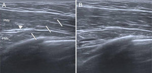 Infiltración ecoguiada de pectoral menor. En la imagenA se observa aguja 22G (flechas blancas) con extremo en el pectoral menor (PMe), localizado profundo al pectoral mayor (PMa), evitando ramas vasculares pectorales (punta de flecha). En la imagenB se visualiza distribución intramuscular del fármaco.