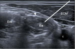 Plano anatómico para la infiltración del escaleno anterior (Ea), que se localiza profundo al esternocleidomastoideo (ECM) y al nervio frénico (punta de flecha). La línea blanca refleja el teórico trayecto a seguir. Se observa el plexo braquial (asterisco) entre escaleno anterior y medio (Em) y en región medial el espacio carotídeo, con la vena yugular interna (Yi) parcialmente colapsada y la arteria carótida (C).