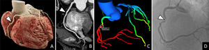 Tomografía computarizada de arterias coronarias (TCC) en un varón de 79años que acude por disnea con sospecha de equivalente anginoso. A)Reconstrucción cinemática. B)Reconstrucción planar curva de la arteria coronaria derecha. C)Reconstrucción volumétrica del árbol coronario con cálculo de FFRCT. D)Coronariografía convencional. La TCC puso de manifiesto una estenosis del 70-99% en el segmento proximal de la arteria coronaria derecha (punta de flecha). En dicha localización se estimó un FFRCT de 0,69 (positivo). La coronariografía convencional confirmó la presencia de la estenosis y se colocó un stent.