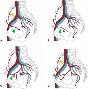 Principales variantes de la corona mortis arterial. A) Origen de la arteria obturatriz (cabeza de flecha verde) en la arteria ilíaca externa (cabeza de flecha naranja). B) Origen de la arteria obturatriz en la arteria epigástrica inferior (AEI) (cabeza de flecha gris). C) Conexión anastomótica (cabeza de flecha verde) entre la AEI y la arteria obturatriz originada en la arteria ilíaca interna (cabeza de flecha morada). D) Rama arterial (cabeza de flecha verde) procedente de la arteria ilíaca externa, que cruza la rama iliopubiana, pero no comunica sistemas arteriales ilíaco interno y externo.
