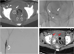 Hemorragia posparto masiva en una mujer de 37 años, tras desgarro del tracto genital durante el expulsivo (parto eutócico). A) Corte axial de la angio-TC en fase arterial, que evidencia foco de extravasación de contraste paravaginal derecho (círculo) procedente de una rama (flecha) originada en la corona mortis arterial derecha (cabeza de flecha). Taponamiento vaginal (packing) con compresas (flechas huecas), que no consigue contener la hemorragia. B) Cateterización selectiva de arteria epigástrica inferior (AEI). Imagen de control de la fluoroscopia que muestra el molde de embolización con copolímero de Etilen-Vinil-Alcohol de la rama implicada en el sangrado, que nace de la corona mortis arterial. El origen de la corona mortis arterial también es embolizado. C) Serie final de control en ASD. Se evidencia ausencia de extravasado; la AEI está preservada (flecha curva). D) Corte axial de la angio-TC en fase arterial que muestra el material de embolización hiperdenso (flechas rojas) y restos de contraste postarteriografía, remansados en el espesor del hematoma paravaginal derecho (estrellas).