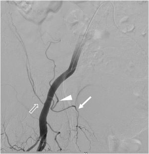 Anatomía de la corona mortis arterial en ASD. Corona mortis (flecha) originada en la arteria epigástrica inferior (cabeza de flecha); arteria circunfleja ilíaca profunda (flecha hueca).