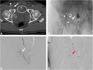 Politraumatismo en un varón de 47 años, con un descenso de la hemoglobina de 4g/dl. A) Reconstrucción MIP de la angio-TC en fase arterial con foco de extravasación de contraste (círculo), que asocia una fractura de la columna anterior del acetábulo derecho (flecha hueca). Variante del origen de la corona mortis arterial (flecha) y arteria epigástrica inferior (AEI) en la arteria femoral profunda (AFP) (cabeza de flecha). B) Arteriografía selectiva de arteria femoral común (AFC) derecha, que confirma el origen de la corona mortis y la AEI (flecha curva) en la AFP. Se observa, además, una bifurcación alta de la AFC, por encima de la cabeza femoral (estrella). C) ASD supraselectiva desde la corona mortis, sin evidenciar focos de sangrado en ese momento. Se realiza embolización empírica dada la cercanía de la línea de fractura a la corona mortis y la localización en la angio-TC del foco de sangrado. D) ASD final de control tras embolización con esferas de 500μm y microcoils (flecha roja).