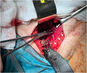 Imagen intraoperatoria de abordaje de Stoppa modificado para tratamiento de fractura acetabular en un varón de 49 años. Se expone cuidadosamente la superficie de la rama iliopubiana (cabezas de flecha) para identificar y ligar los vasos de la corona mortis (flecha).