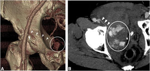 Vasoespasmo de la corona mortis arterial por hemorragia grave tras traumatismo pélvico en una mujer de 69 años, con fracturas asociadas (no mostradas). A) Reconstrucción tridimensional ampliada de hemipelvis derecha. Se observa la presencia de una corona mortis arterial (cabezas de flecha), originada en la arteria epigástrica inferior (flecha), que se dirige hacia el foco de extravasación de contraste (círculo). La arteria se encuentra muy disminuida de calibre por vasoespasmo. B) Reconstrucción MIP de la angio-TC en fase arterial que muestra una coronamortis arterial muy disminuida de calibre, con una gran extravasación de contraste en pelvis menor (círculo).