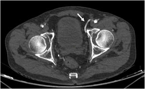Identificación de la corona mortis arterial en la angio-TC, fase arterial. Varón de 66 años a quien se realiza una angio-TC para valoración de enfermedad arterial periférica. La arteria obturatriz se origina en la arteria epigástrica inferior izquierda (corona mortis arterial), y presenta una trayectoria medial describiendo un arco anterior al acetábulo (flechas).