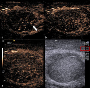 Realce normal del testículo en CEUS. Después de la inyección del medio de contraste, (a) se observa inicialmente en la fase arterial un realce de las ramas de la arteria testicular (flecha), (b) con realce progresivo del parénquima y (c) una meseta de captación en la fase venosa. Se recomienda mantener un índice mecánico bajo (recuadro rojo) para evitar la rotura precoz de las microburbujas del contraste.