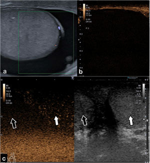 Paciente de 25 años con torsión testicular en contexto de dolor escrotal agudo derecho. (a) Testículo derecho sin vascularización parenquimatosa evidente en el modo Doppler. (b) Se realiza CEUS que muestra ausencia de captación testicular, (c) que se confirma de forma más evidente en un plano axial comparativo entre el testículo derecho (flecha negra) y el izquierdo (flecha blanca) que muestra captación.