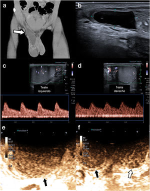 Seroma inguinal posquirúrgico con compromiso vascular testicular secundario. Varón de 54 años con antecedentes de herniorrafia reciente por hernia inguinal indirecta derecha, que acude por palpación de masa inguinal y molestia escrotal derecha. (a) La TC abdominal con contraste muestra un seroma posquirúrgico en el canal inguinal derecho (flecha), (b) visible en la ecografía como una colección anecoica. (c) El Doppler espectral del testículo izquierdo (sano) muestra una onda arterial normal, (d) mientras que en el testículo derecho se evidencia una onda arterial de resistencia disminuida respecto a la contralateral. (e) En la CEUS, el testículo derecho muestra captación preservada (flecha negra), (f) aunque ligeramente reducida y enlentecida respecto al testículo contralateral (flecha blanca). El paciente fue reintervenido para el drenaje del seroma, con mejoría clínica y normalización de la vascularización testicular en el control ecográfico posterior.